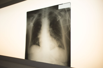 chest x-ray hanging on the monitor