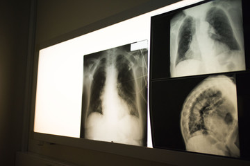 chest x-ray hanging on the monitor