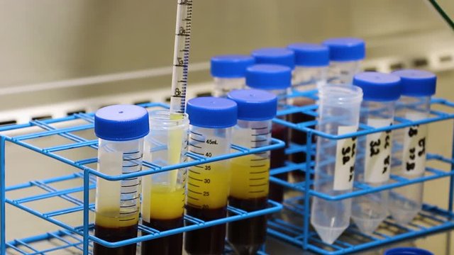 Slowly Siphon Yellow Platelets and Plasma Off the Top of Red Whole Blood After Being Spun In A Centrifuge in a Lab - PRP and Stem Cell Process