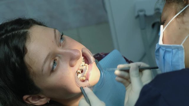 Visit to the dentist, installation of the bracket system and correction of the malocclusion, top view. Orthodontist corrects the established bracket close-up.