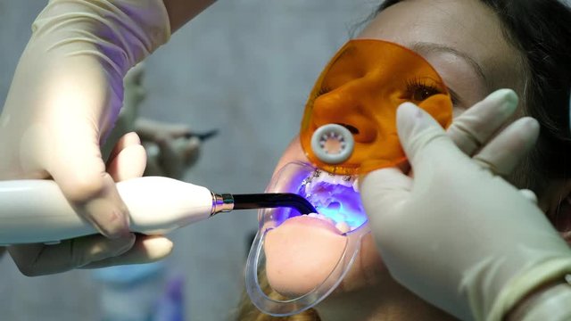 Assistant shines with a dental polymerization ultraviolet lamp to fixation the brackets close-up. Visit to the dentist, installation of the bracket system