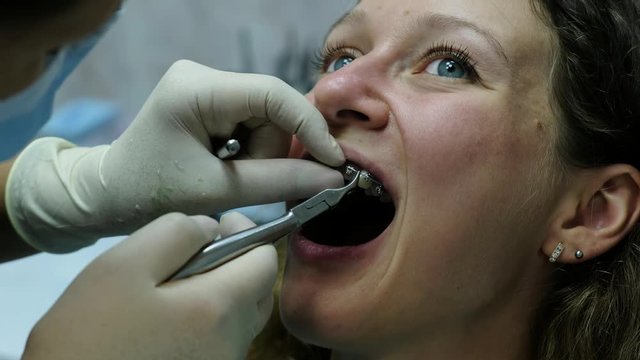 Visit to the dentist, installation of the bracket system. Orthodontist establishes a metal orthodontic arch in the braces