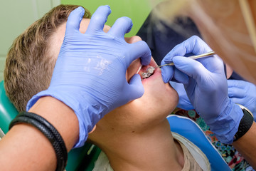 The doctor's hands attaching brackets on the teenager's teeth.