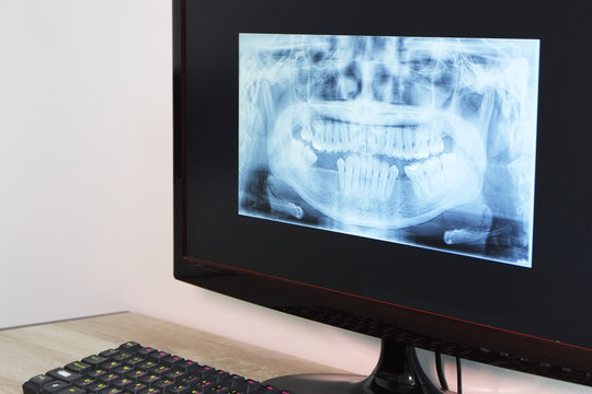 x-ray of teeth on computer screen