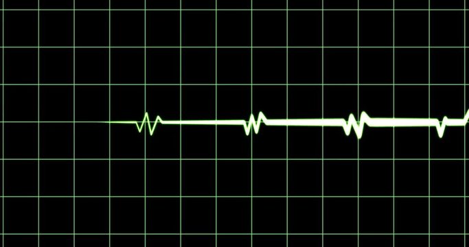 ECG, electrocardiogram showing a slow heart rate, vital signs data screen of intensive care unit, falling pulse, death, artwork in medicine, green wave on black, 4k loop
