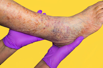 Close-up of skin with varicose veins on senior male leg. Concept of dry skin, old senior people,...