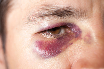Man's face after the fight and assault. Caucasian male Emotional Portrait with a Real Bruise after...