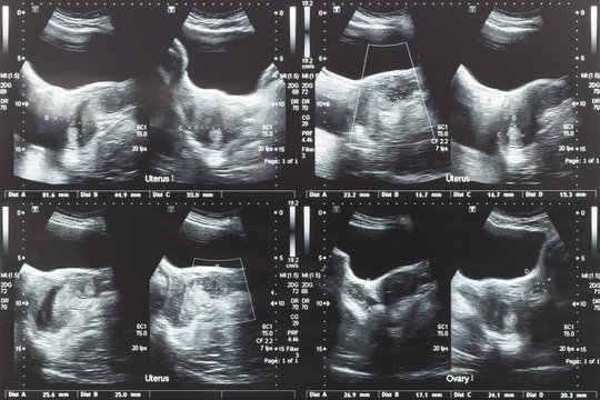 Ultrasound image of lower abdomen, ovary and uterus with tumor or uterine fibroid, leiomyoma of female woman patient for gynecological medical exam, analysis and test