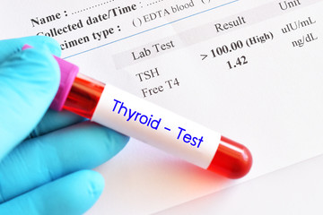 Fototapeta premium Blood sample tube with abnormal thyroid hormone test result 