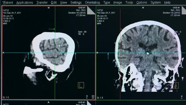 Brain scanning process displayed on a monitor