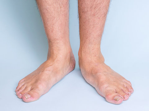 Legs of a man with a pronounced flat feet. Front view.