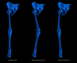 Alignment types of disease lower half limbs or leg bone problem- normal- knock knee- bowlegs or...