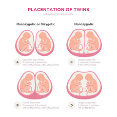 Twin types infographic elements in flat design. Monozygotic or Dizygotic Placentation of twins medical illustration and icons isolated on white background.