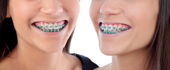 Twins sisters with brackets
