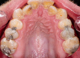 close up of teeth, upper jaw, intraoral © Dirk