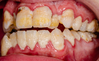 serious dental plaque, frontal teeth intraoral