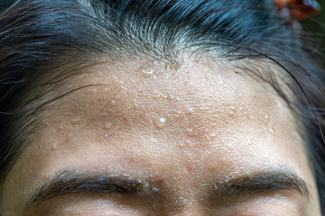Close up sweat on forehead - obrazy, fototapety, plakaty