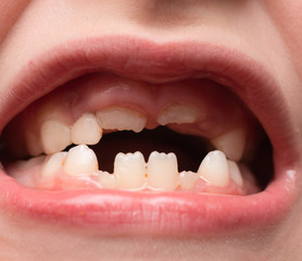 baby mouth with teeth