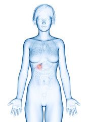 Fototapeta premium medically accurate 3d rendering of a female´s gallbladder cancer
