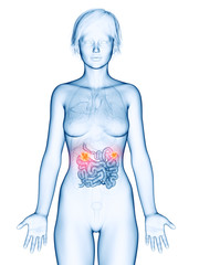 medically accurate 3d rendering of a female´s small intestine cancer