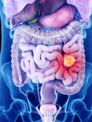 3d rendered medically accurate illustration of intestine cancer