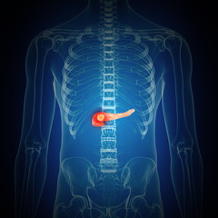 3d rendered medically accurate illustration of pancreas cancer