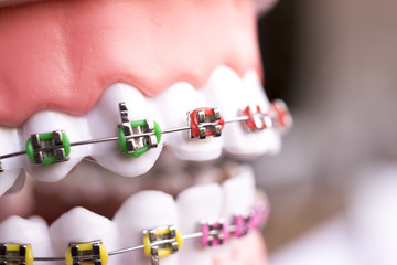 Dental metal brace teeth model