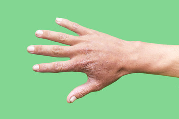 hand of a man with a scar isolated on a green background