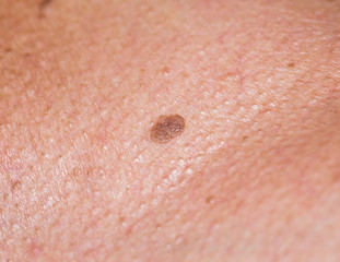 Moles and various skin conditions macro