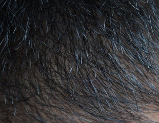A middle-aged man with hair loss. Baldness