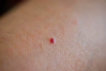 red moles on the skin
