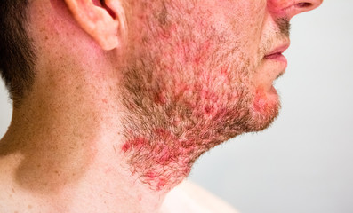 Detail of man's chin with seborrheic dermatitis in the beard area