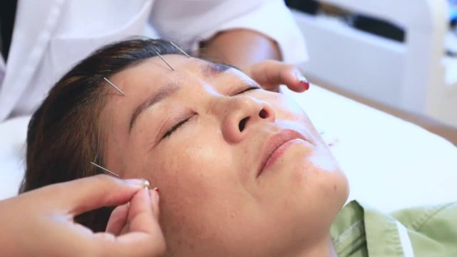 acupuncture treatment on woman face