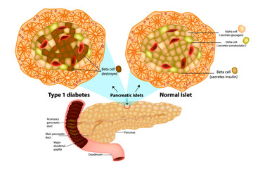 The pancreas has many islets that contain insulin-producing beta cells and glucagon-producing. Type 1 diabetes ( Beta cell destroyed). 