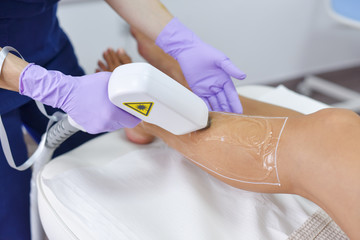 Epilation with a diode laser, hair removal with laser