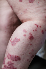 Close up ill allergic rash, eczema skin of patient , atopic dermatitis symptom skin detail texture...