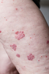 Close up ill allergic rash, eczema skin of patient , atopic dermatitis symptom skin detail texture , Fungus of skin ,The concept dermatology, treatment. Red spots on psoriasis skin. Feet of a woman