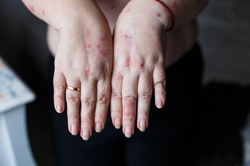 Psoriasis vulgaris on the womans hands with plaque, rash and patches on skin. Autoimmune genetic...