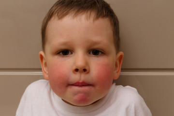 the boy has red cheeks, a rash on his cheeks in the child, a rash on his cheeks from allergies, an...