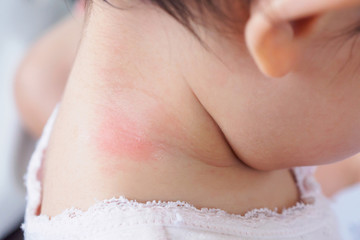 baby skin rash and allergy with red spot cause by mosquito bite at neck