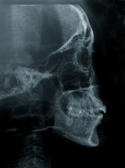 radiography of human skull side view