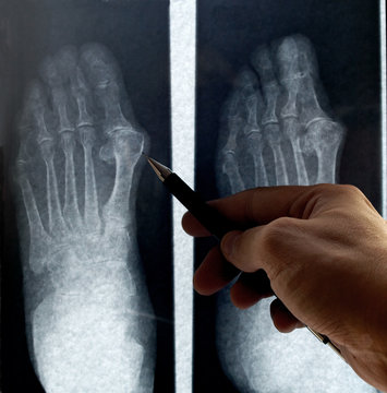 specialist doctor anayzes foot radiography at x-ray film viewer