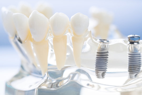 implant and orthodontic model for student to learning teaching model showing teeth.