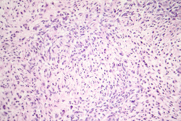 Light micrograph of malignant cells, photo of cancerous tumor under microscope