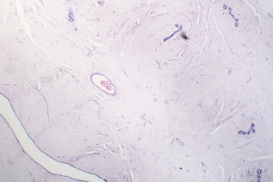 Fibroadenoma, a benign brest tumor, light micrograph, photo under microscope