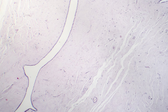 Fibroadenoma, a benign brest tumor, light micrograph, photo under microscope