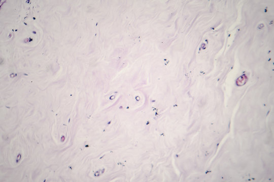 Fibroadenoma, a benign brest tumor, light micrograph, photo under microscope