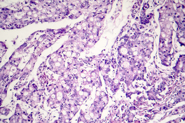 Mucinous carcinoma of the stomach, light micrograph, photo under microscope