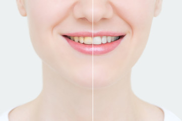 Perfect smile before and after bleaching. Dental care and whitening teeth.Face close-up.