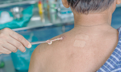 abscess wound